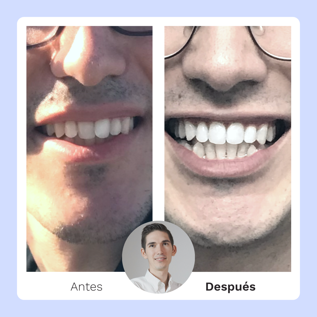 Fotos del antes y después de usar alineación dental invisible