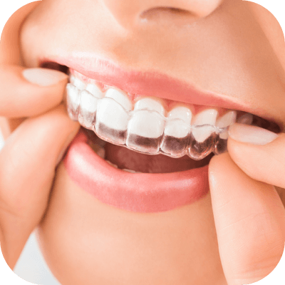 Sonrisa con alineadores Moons